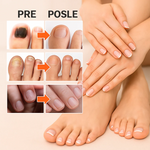 3u1 Fungus Protiv Gljivica - Recite Zbogom Gljivicama na Noktima Jednom Zauvek