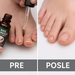 3u1 Fungus Protiv Gljivica - Recite Zbogom Gljivicama na Noktima Jednom Zauvek